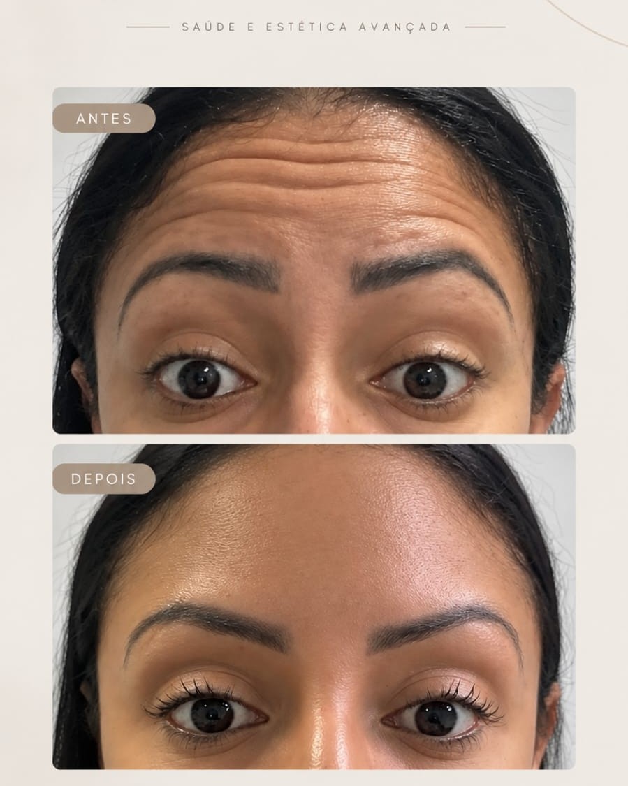 Antes e depois da suavização das linhas de expressão da testa de uma paciente